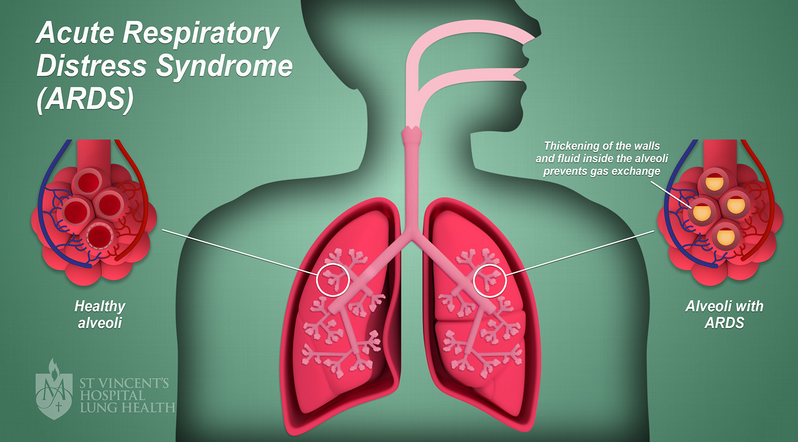 Mengetahui Tentang Kondisi Acute Respiratory Distress Syndrome